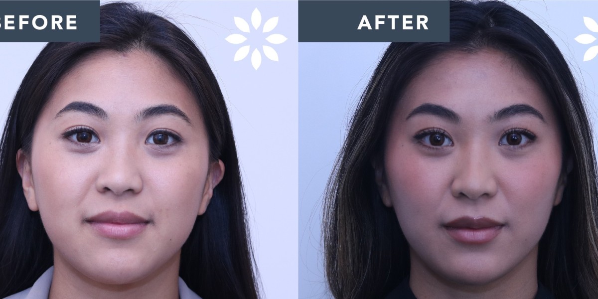 How to get a slimmer face with Buccal Fat Removal?