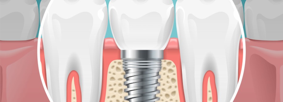 Nuteeth dental Implant center Cover Image