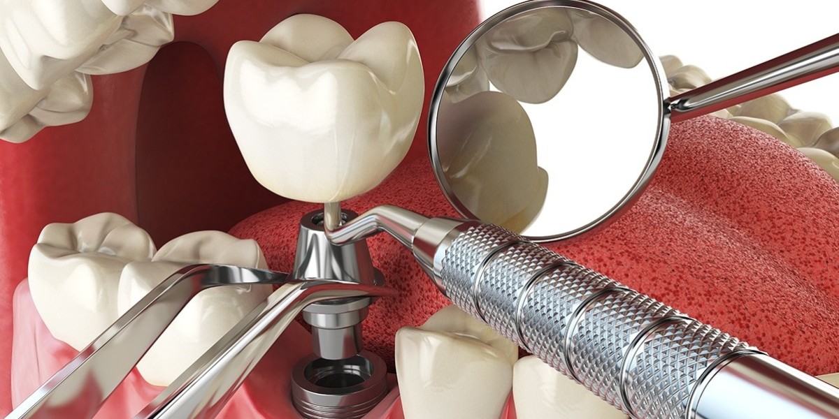 Dental Implants: The Future of Tooth Replacement