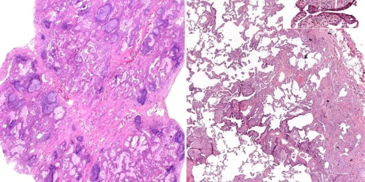 Idiopathic Pulmonary Fibrosis (IPF) Market Size, 2024 Analysis, Industry Trends and Forecasts to 2034