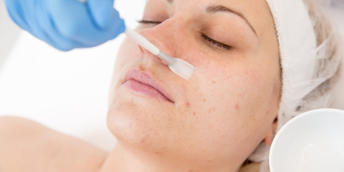 Luminous Layers Enhancing Complexions with Riyadh's Premium Chemical Peel Treatments