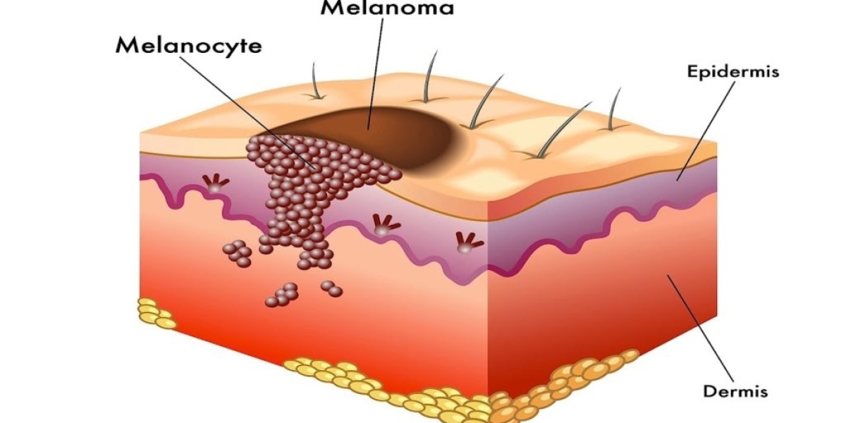 2024, Melanoma Market Research Report Analysis by 2034