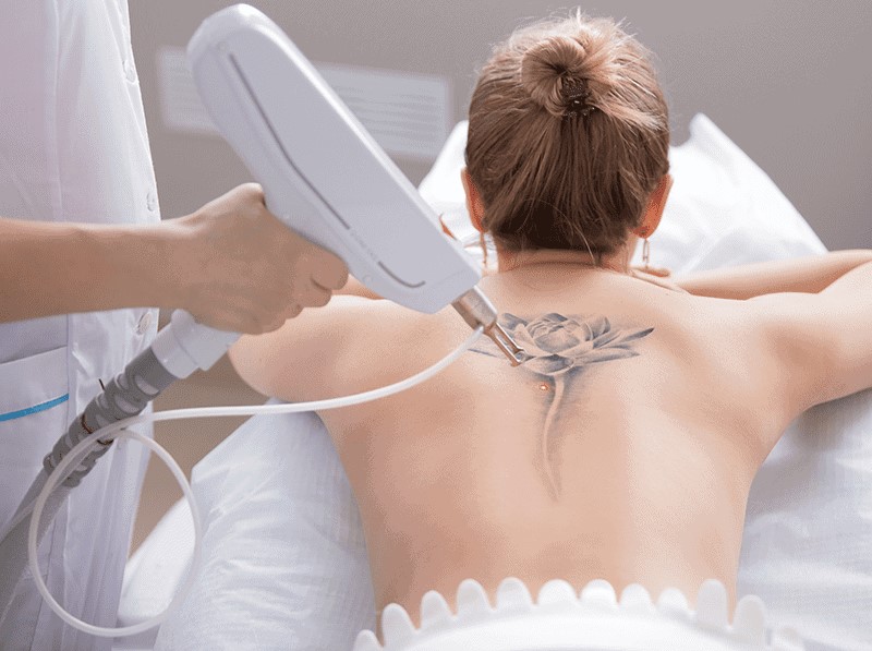 Laser Tattoo Removal for All Skin Types | Vipon