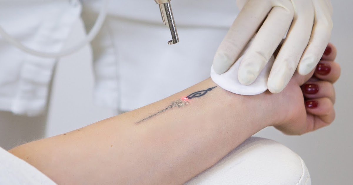 The Ultimate Guide to Laser Tattoo Removal in Dubai