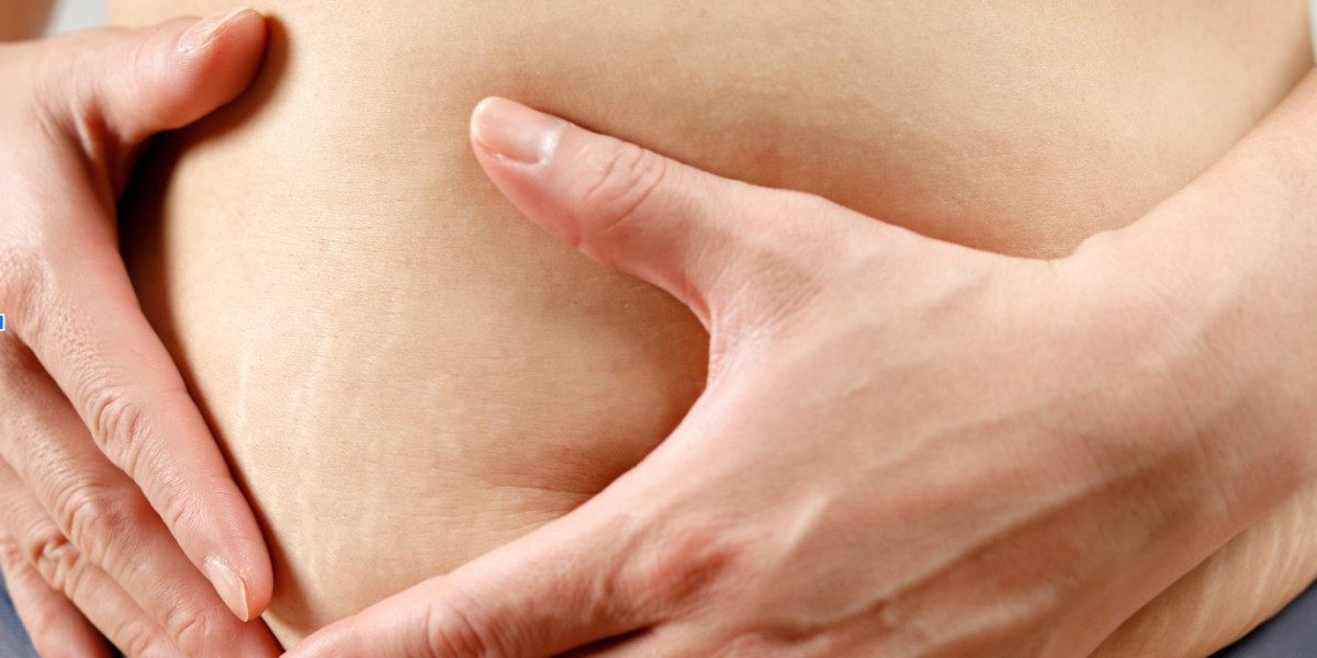 Smooth and Radiant: Laser Stretch Mark Solutions in Dubai