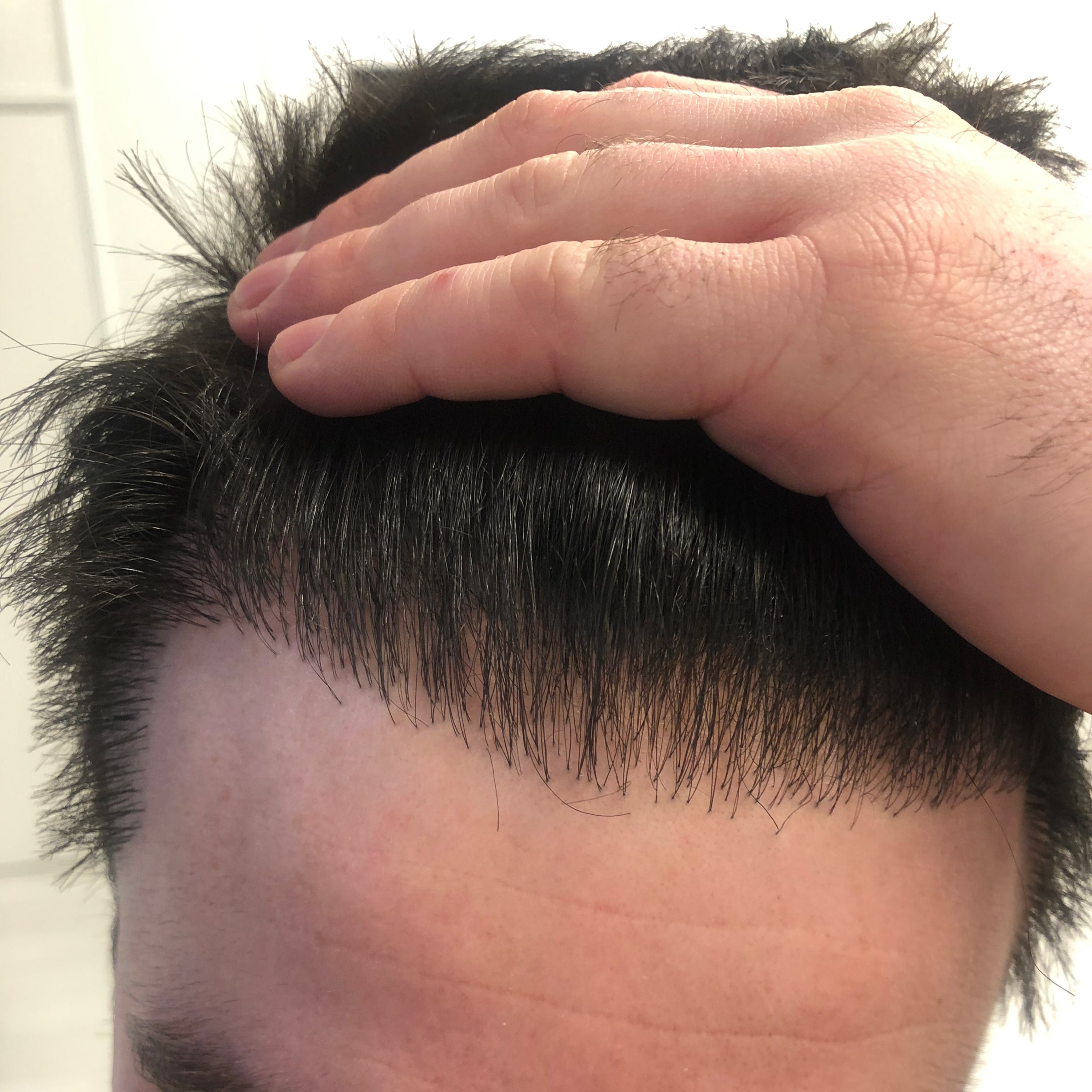 Why Scalp Micropigmentation Outperforms Hair Transplants