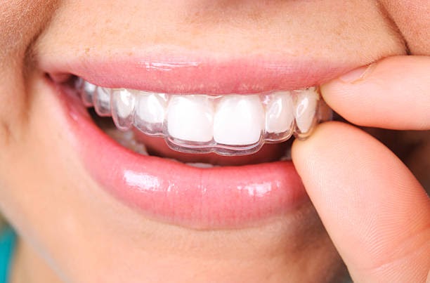 Why Invisalign is better than Braces?