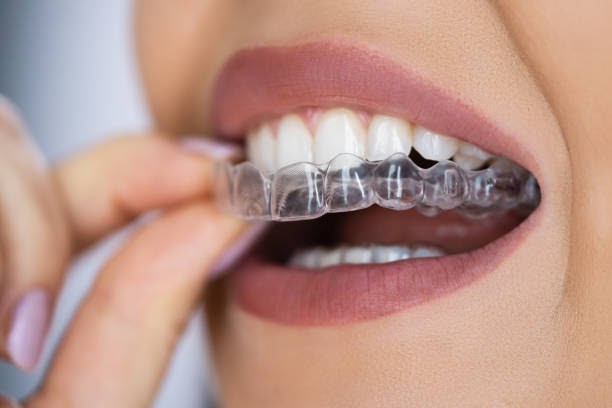 Get A Perfect Grin with Ease with Invisalign