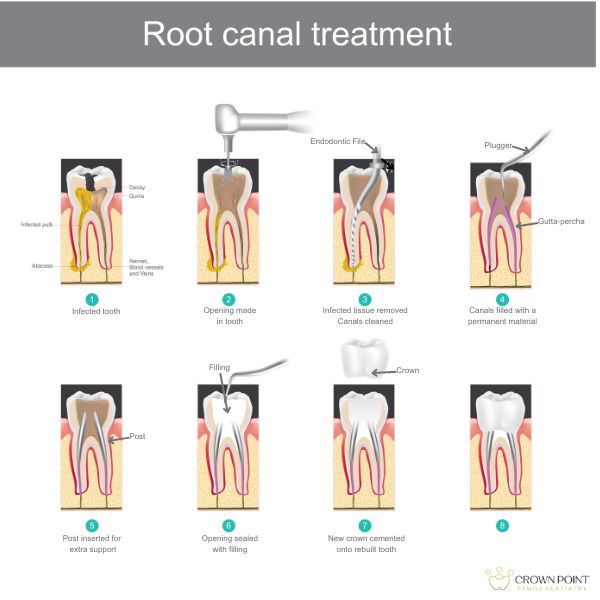 Root Canal Treatment In Charlotte NC | Crown Point