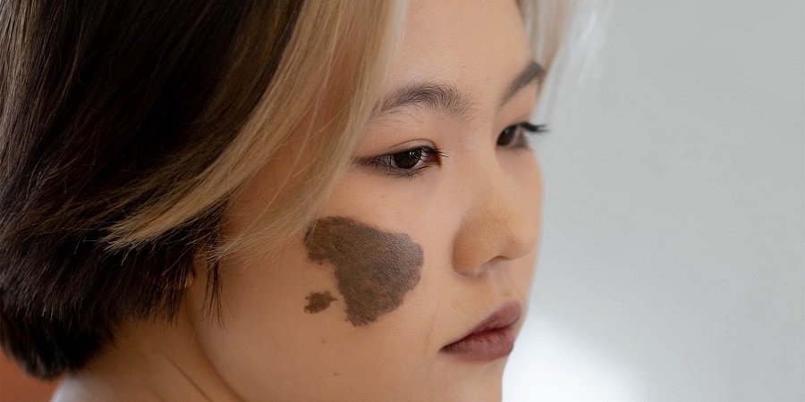 Birthmark Removal In Riyadh & Saudi Arabia | Cost & Price